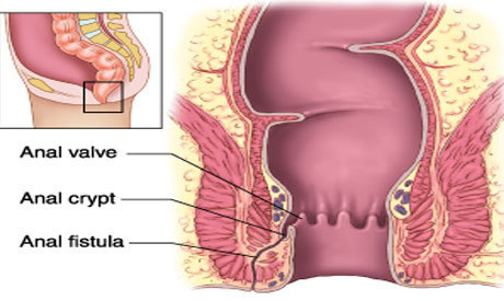 piles surgery in chennai